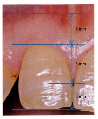 上顎右側中切歯の口腔内写真を別に示す。歯周組織検査の結果、プロービングデプス、アタッチメントレベルともに2mmであった。口腔内写真に参考となる測定値を示す。臨床的付着歯肉幅はどれか。