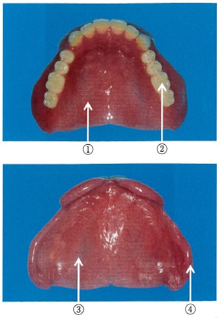 上顎全部床義歯の写真を別に示す。部位と名称との組み合わせで正しいのはどれか。2つ選べ。