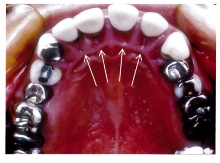 46歳の女性、口腔の乾燥と歯肉の腫脹を訴え来院した。初診時の口蓋側面観の口腔内写真を別に示す。矢印が示す徴候の原因で考えられるのはどれか。