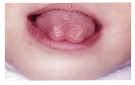 		3歳の女児、歯の形の異常を訴えて来院した。口腔内写真を別に示す。正しいのはどれか。		