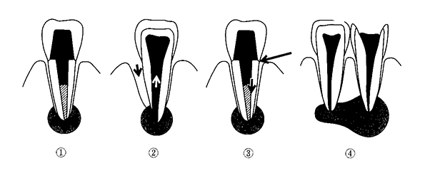 		根尖性歯周炎の図を示す。矢印は感染経路を示す。コロナルリーケージはどれか。		