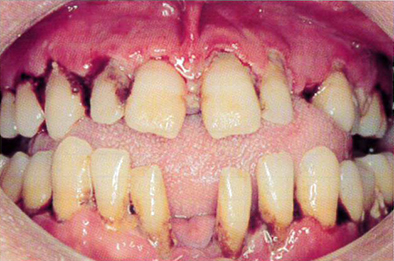 		34歳の男性。歯肉の疼痛を訴えて来院した。3日前から歯肉に強い自発痛と接触痛を感じているという。現症として38.2℃の発熱と強い口臭を示した。初診時の口腔内写真を別に示す。疑われるのはどれか。		
