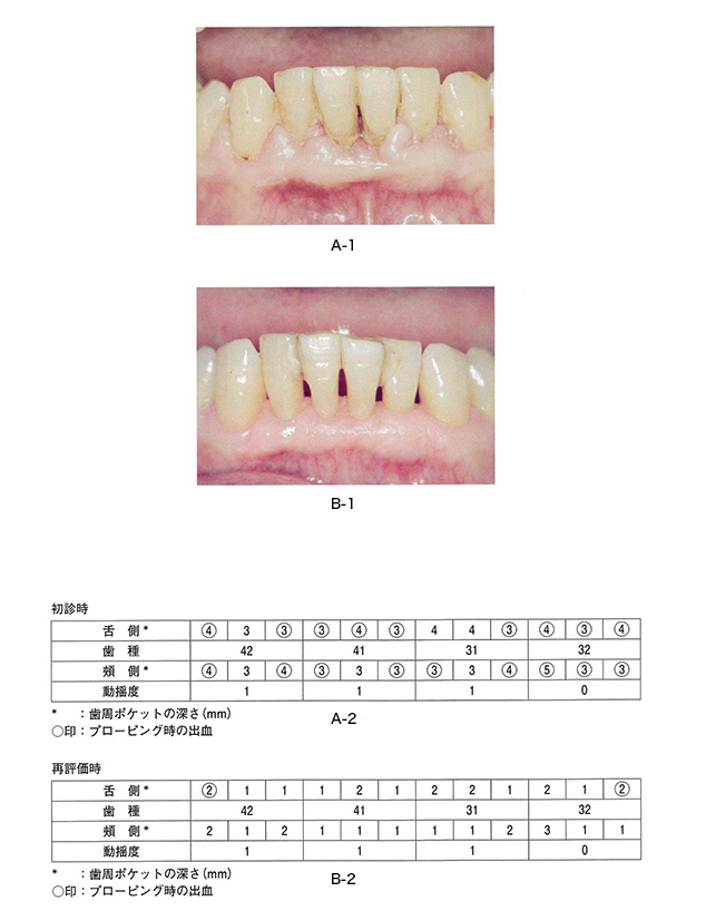 		55歳の女性。下顎左側前歯部歯肉の腫脹を訴えて来院した。2ヶ月前から気付いていたが放置していたという。慢性歯周炎と診断され歯周基本治療を行った。初診時の検査でCEJから歯肉辺縁までの距離はいずれの部位も0mm、再評価時は2mmであった。初診時の口腔内写真（A-1)と歯周組織検査結果の一部（A-2）、再評価時の口腔内写真（B-1）と歯周組織検査結果の一部（B-2）を別に示す。改善したのはどれか。2つ選べ。		