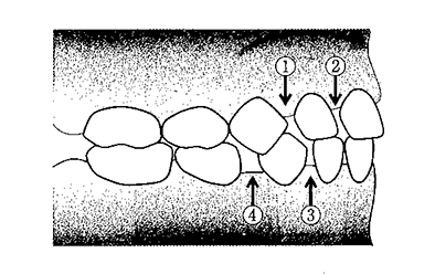		口腔内写真を別に示す。歯列弓形態を表すのはどれか。2つ選べ。		