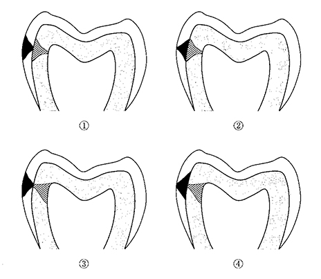 		平滑面う蝕におけるエナメル質う蝕を黒塗りで、象牙質う蝕を斜線で示す。正しいう蝕円錐の形態はどれか。		