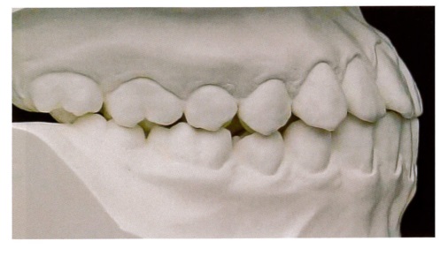 		口腔模型の写真を別に示す。Angleの分類はどれか。		
