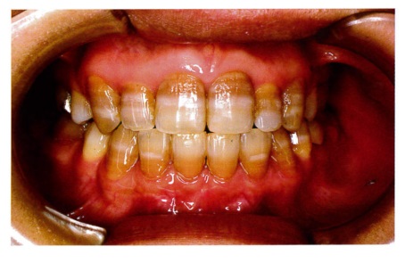 		45歳の女性、歯の着色を気にして来院した。口腔内写真を別に示す。着色の原因と考えられるのはどれか。		