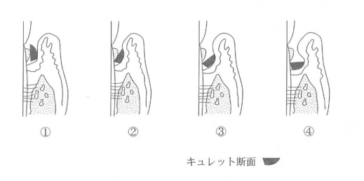 		歯石除去時のグレーシータイプキュレットと歯面の図を示す。操作角度で正しいのはどれか。		
