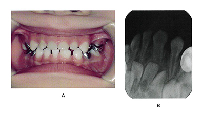 		4歳の男児。下顎左側乳切歯の形の違いを気にして来院した。初診時の口腔内写真(写真A)とエックス線写真(写真B)を別に示す。歯の形態異常はどれか。		