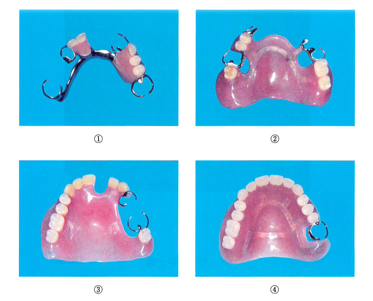 		部分床義歯の写真を別に示す。複合義歯はどれか。2つ選べ。		