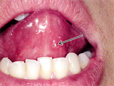 		26歳の女性。舌下面の異常を訴えて来院した。2か月前から舌下面の腫脹に気付き、病変の増大と縮小を繰り返しているという。口腔内写真を別に示す。腫脹を矢印で示す。考えられるのはどれか。		